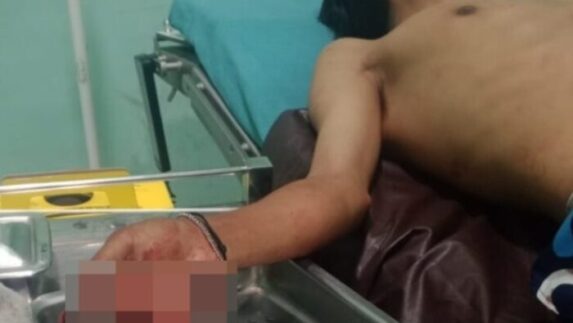 Kawanan Begal di Deli Serdang Bacok Tangan Korban Hingga Nyaris Putus