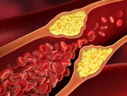 Ini Cara Alami Turunkan Kolesterol Menurut Dokter